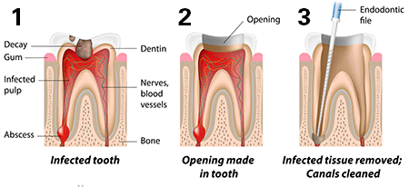 root-canal-stages-1
